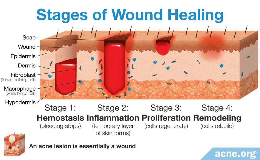 Stages Of Wound Healing Process My Xxx Hot Girl