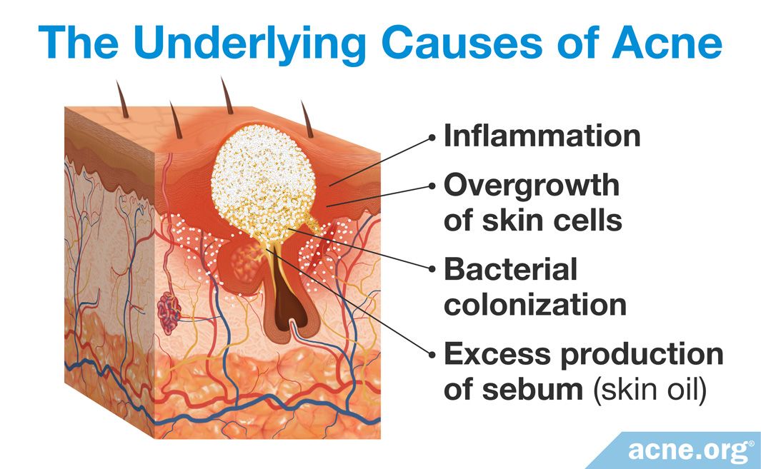 The Role Of Bacteria In Acne 6147