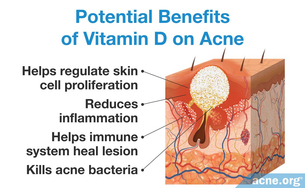 Does Vitamin D Help Treat Acne?