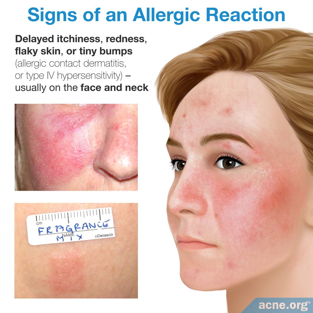 What Does Hypoallergenic Mean Acne Org