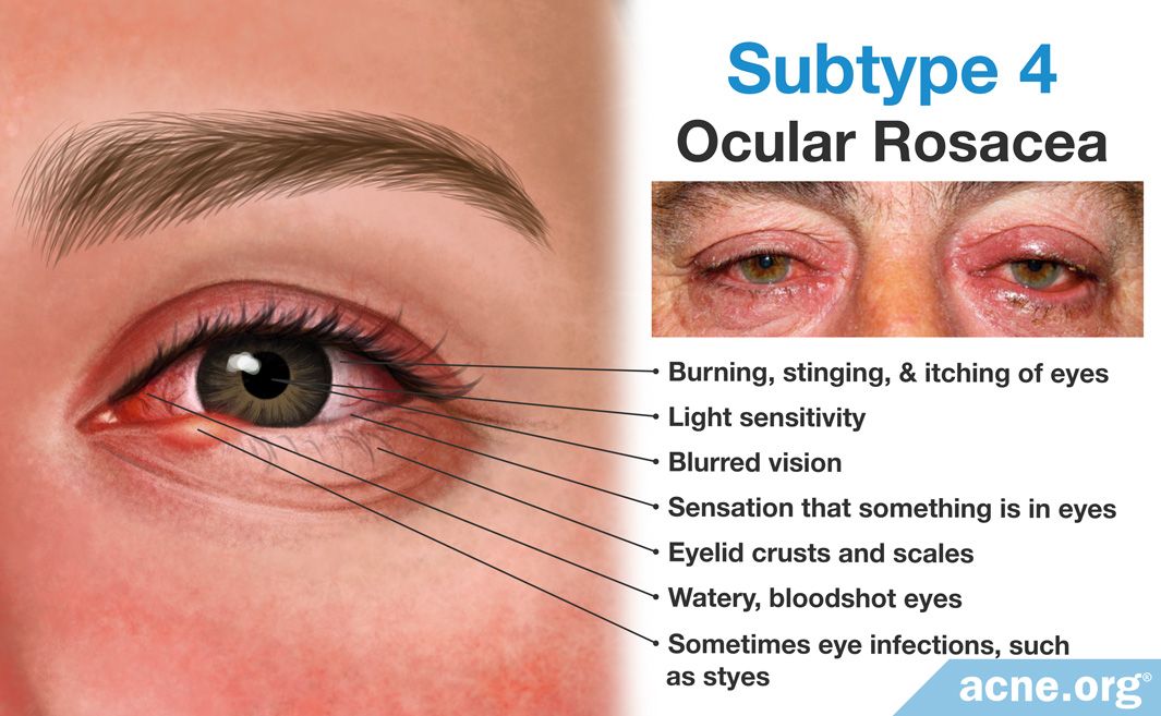 Rosacea - Information and Treatment Options - Acne.org