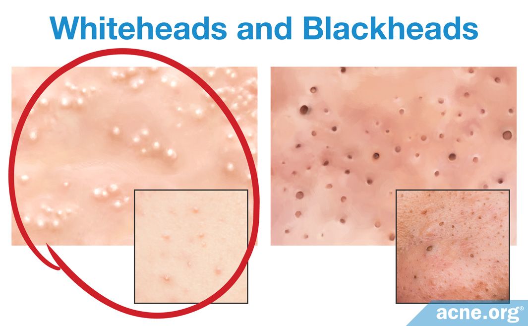 What Is A Whitehead Acne