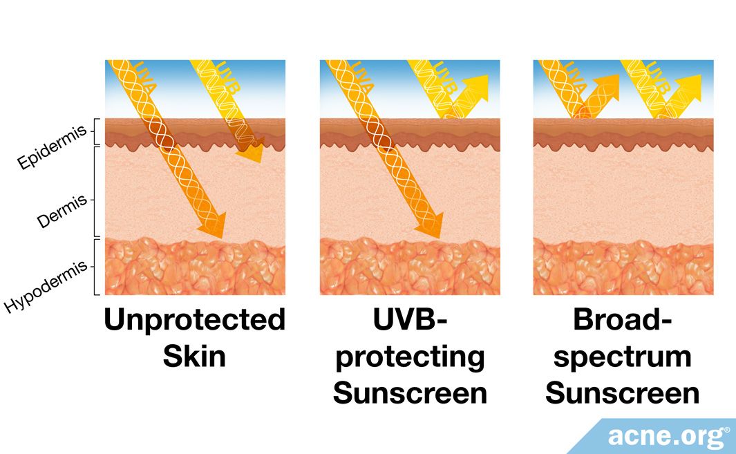 What's the Difference Between UVA and UVB Rays? - Acne.org