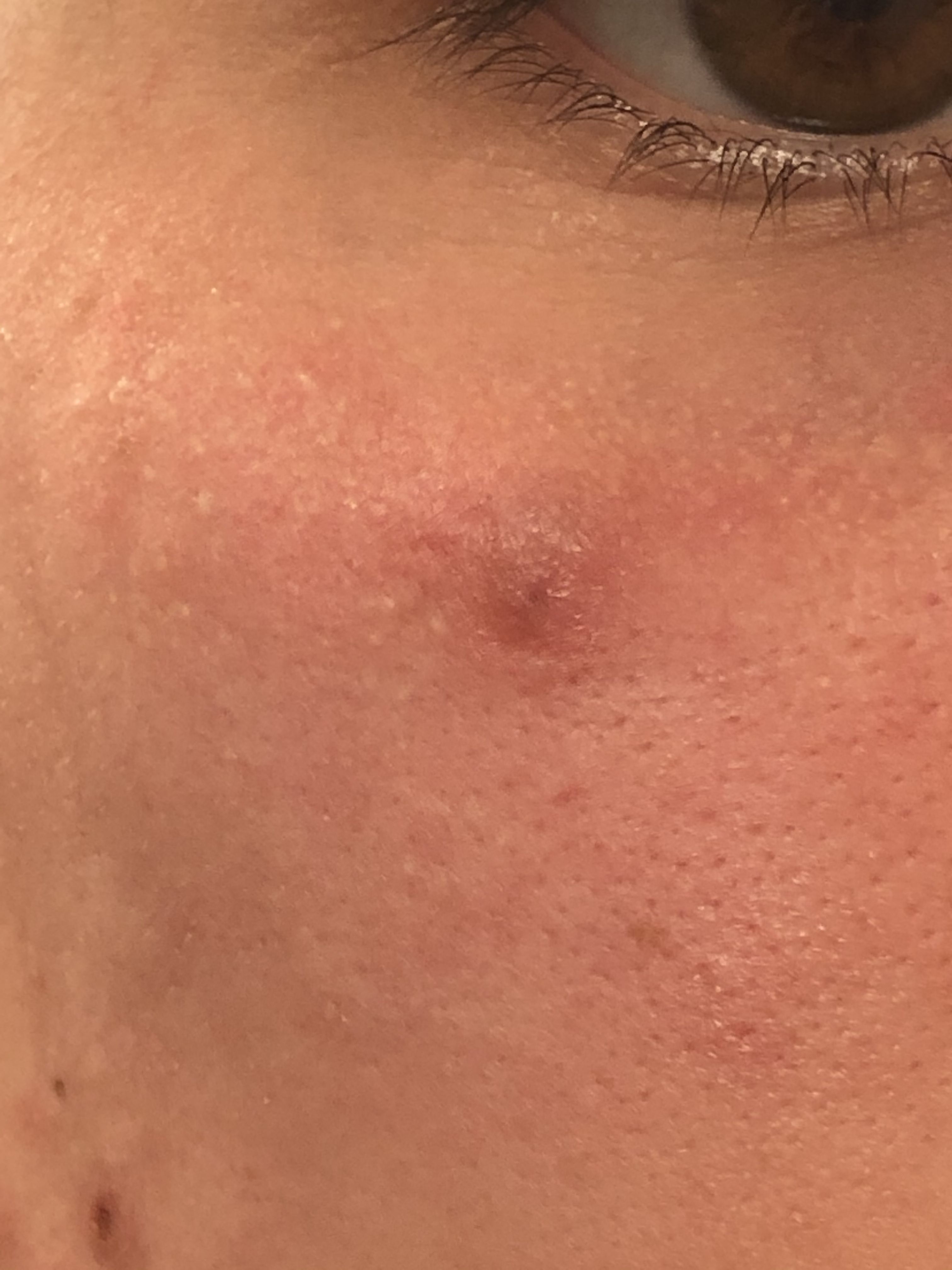 Mysterious Bump Under Eye HELP! — It’s been a month! - General acne