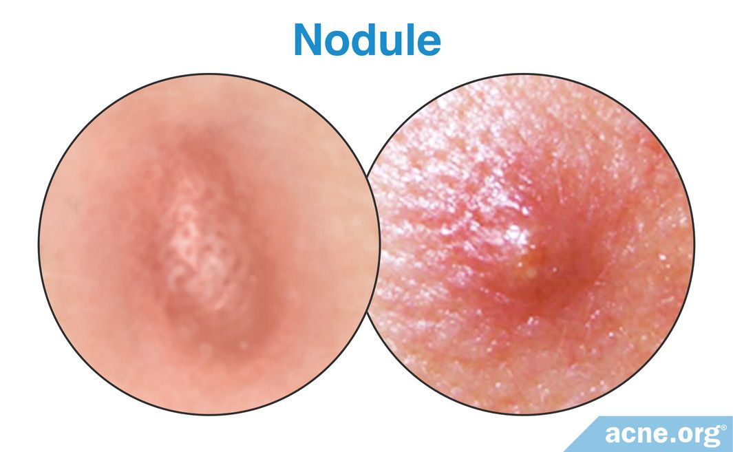 Nodule