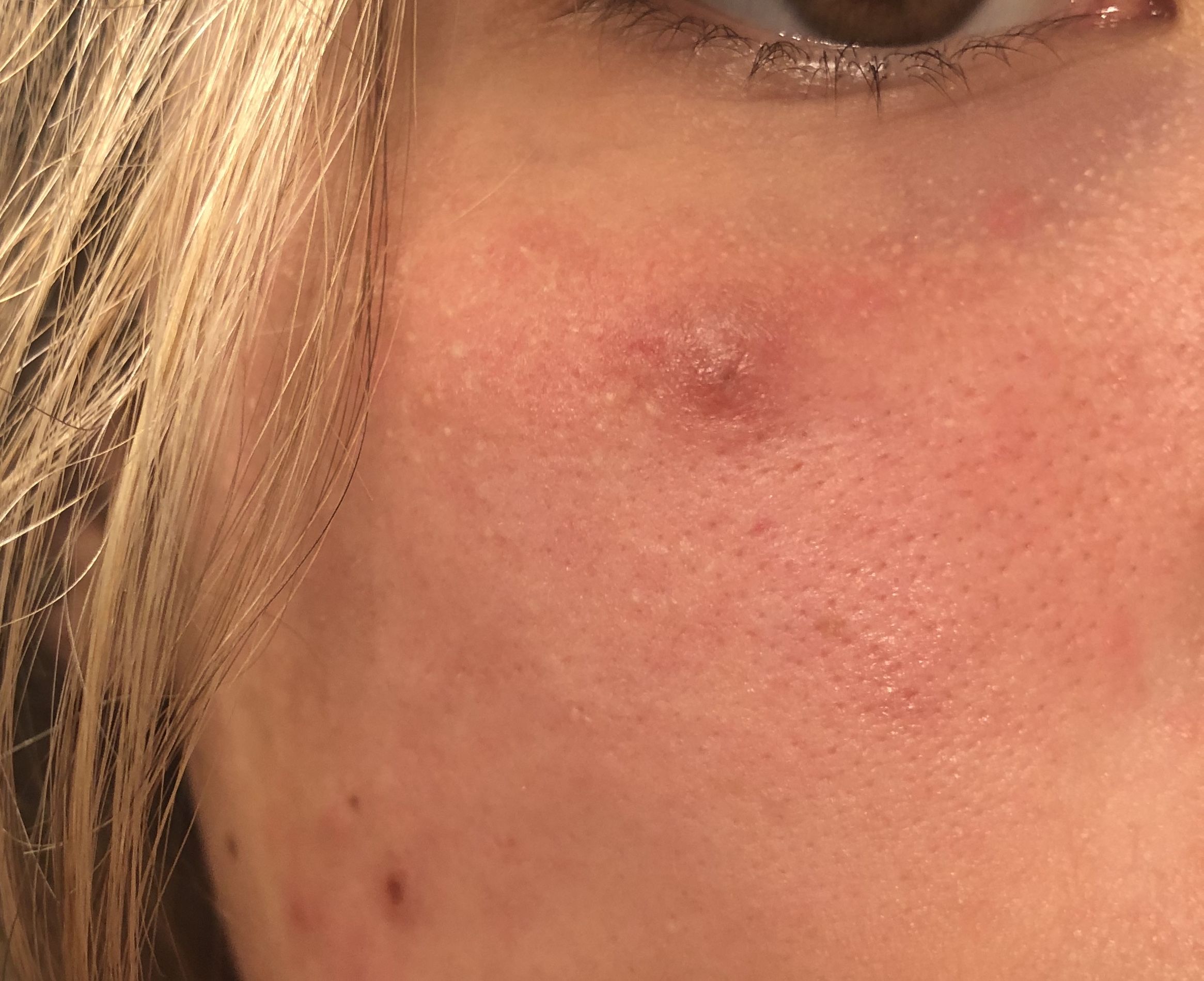 Skin Bump Under Eye