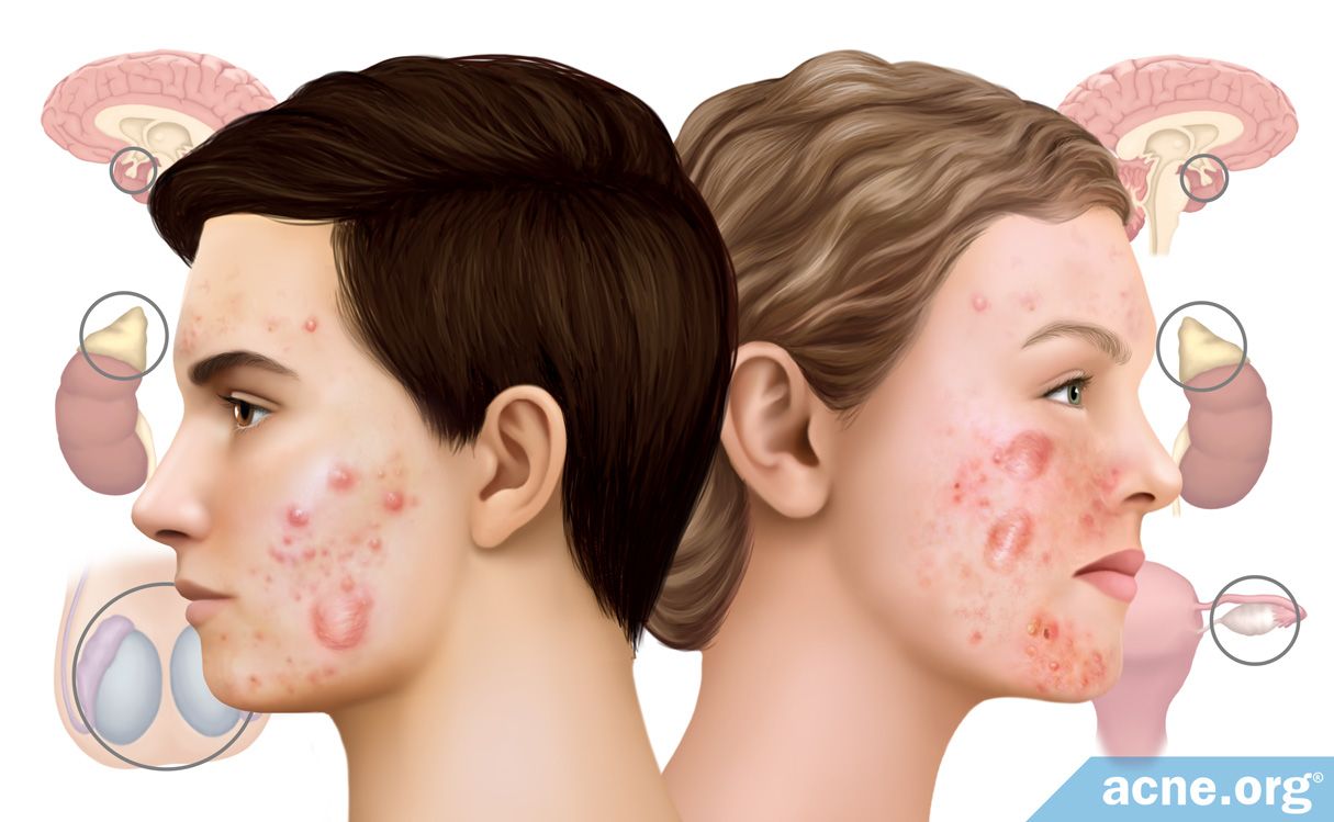 Cysticacne What Causes Cystic Acne 9 Treatment Types