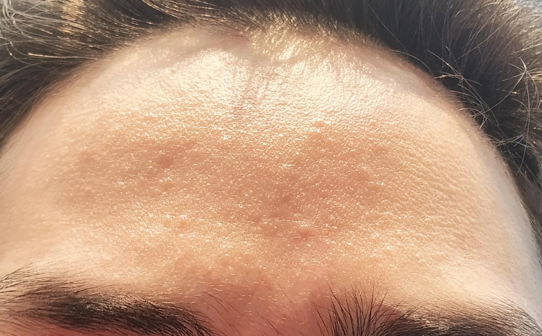 Rough Bumpy And Sandy Texture Especially On Forehead And Thousands Of