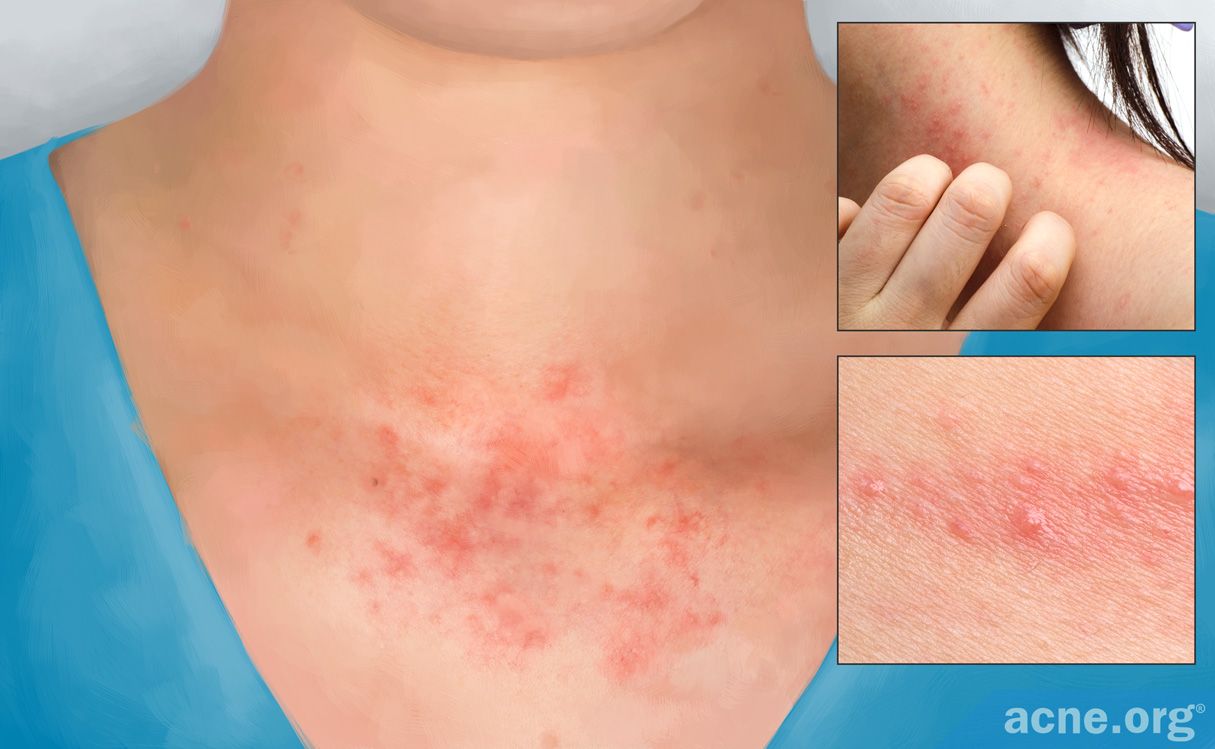 Teclabs Com What Causes Contact Dermatitis What Is Contact Dermatitis