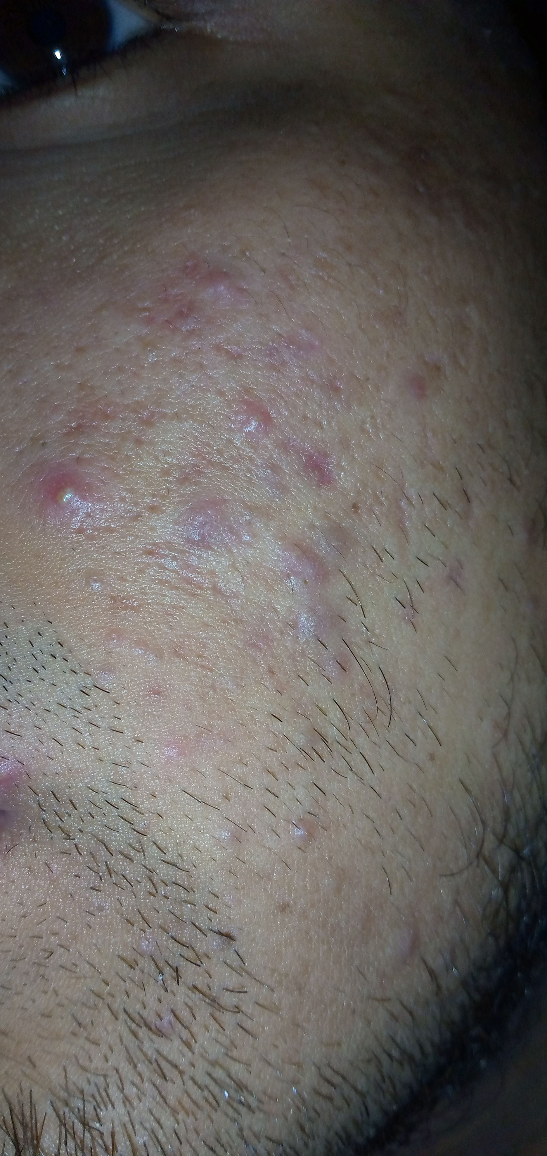 How Can I Get Rid Of Extreme Red Bumps On My Cheeks General Acne 