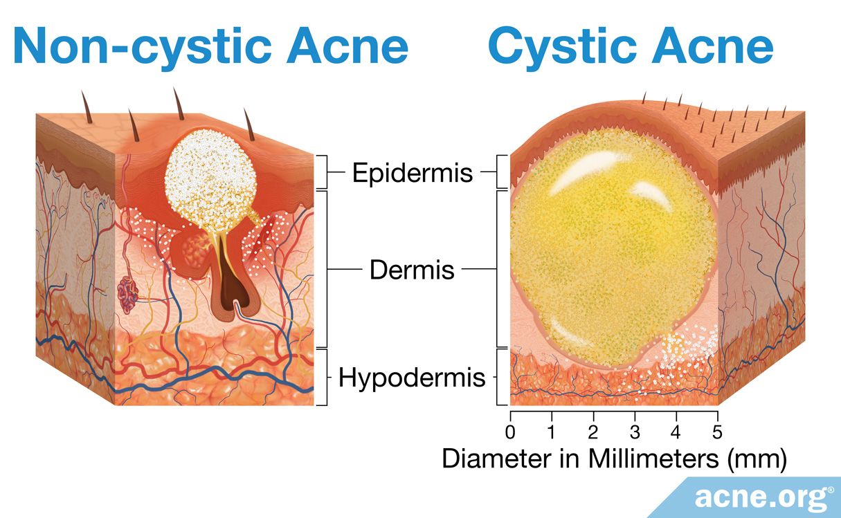 Regular Acne Vs Cystic Acne What s The Difference Acne