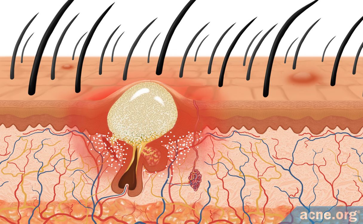 Scalp Acne Info Treatment Options Acne Org