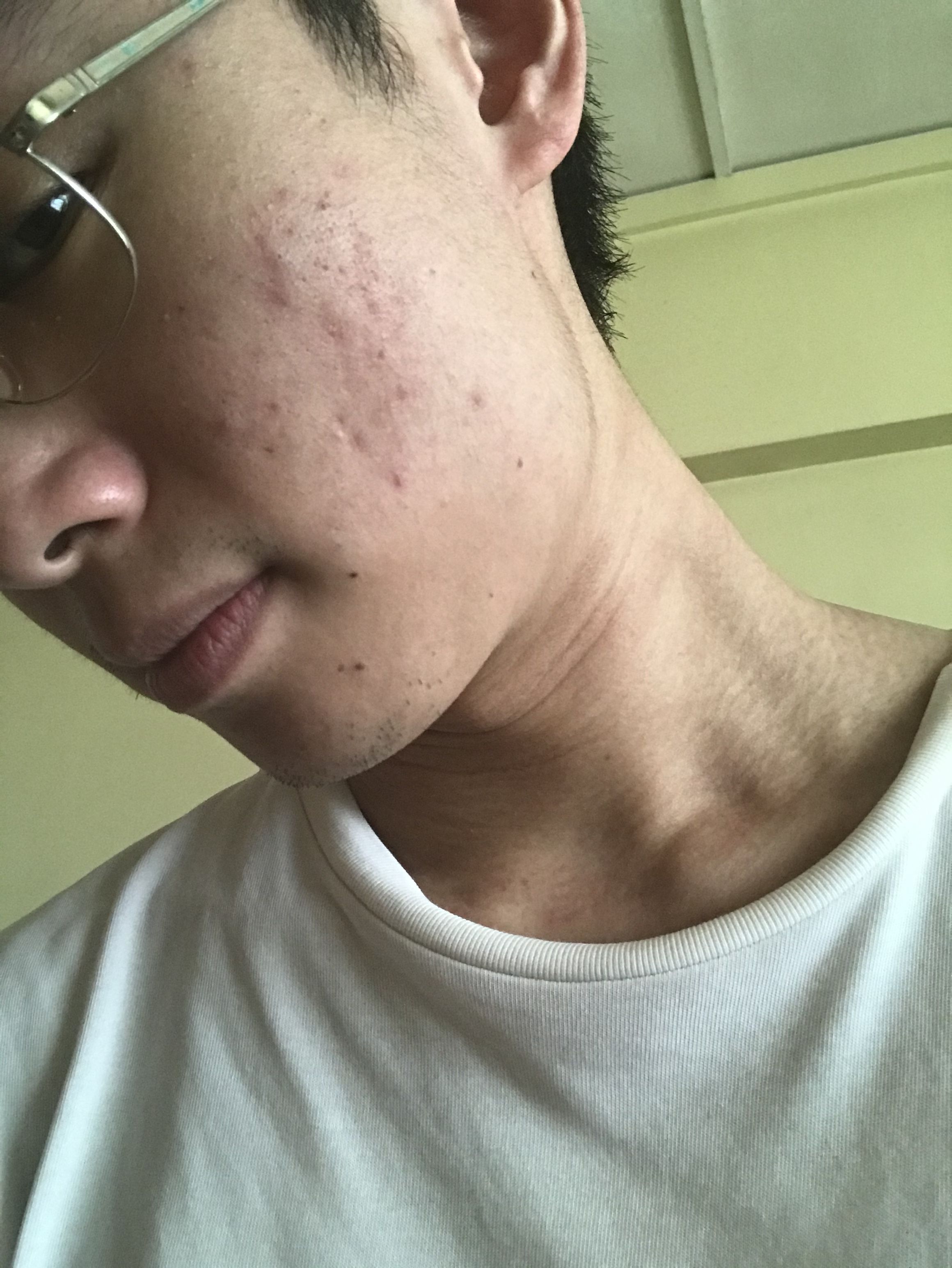 Acne Marks Or Scars How To Deal General Acne Discussion Acne