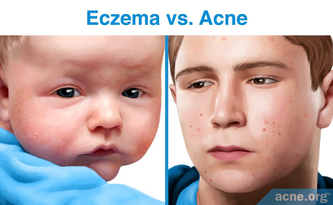 Eczema (Atopic Dermatitis)