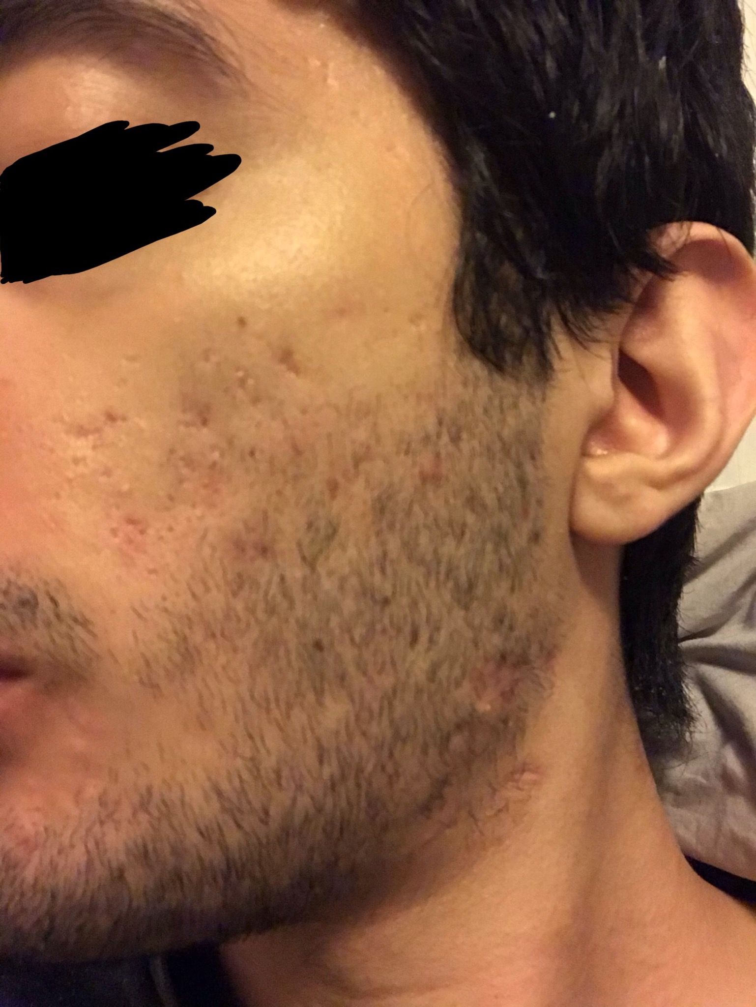 How severe is my acne scars? What to do about it? - Scar treatments