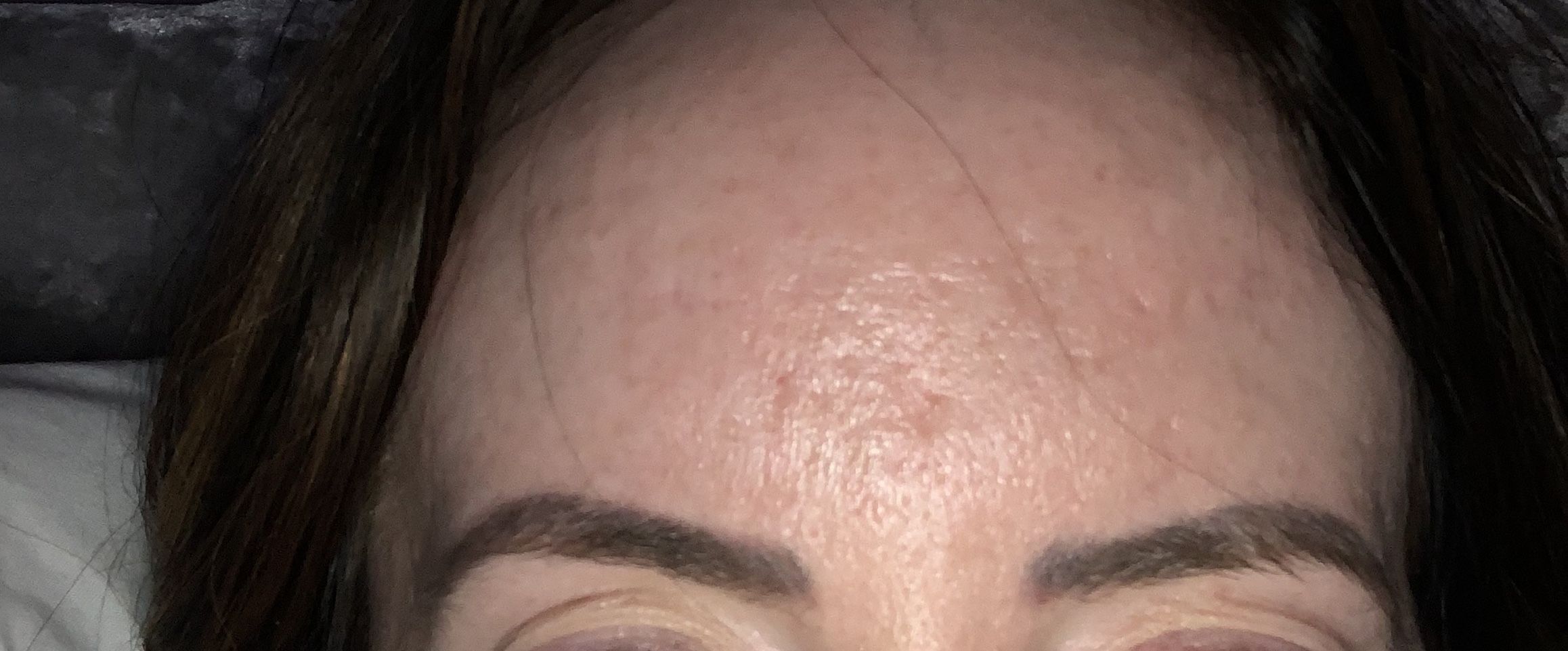 Forehead Acne Scars Scar Treatments