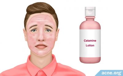 calamine lotion a fejbőr pikkelysömörére