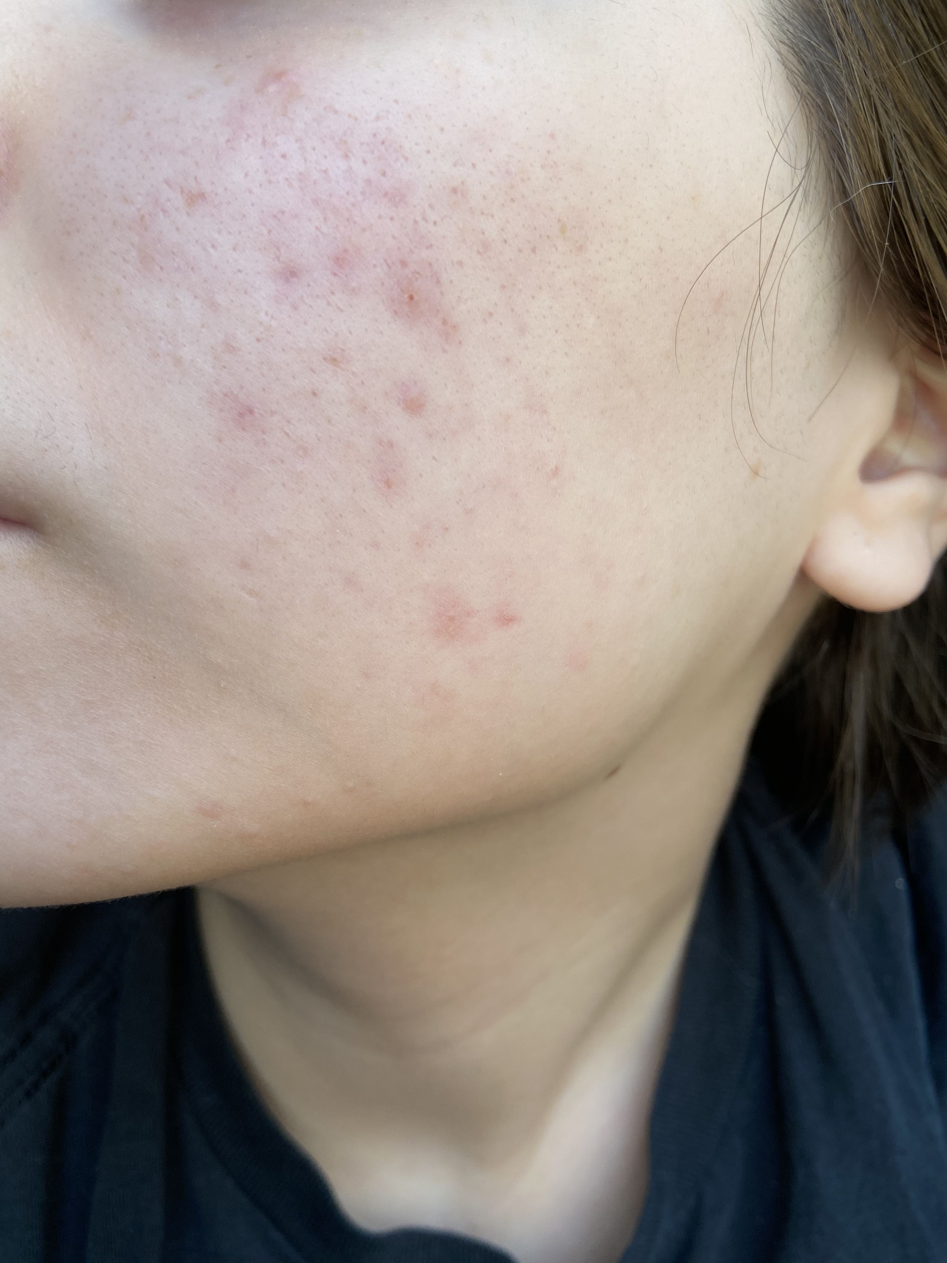 Do you think this is hyperpigmentation? - Hyperpigmentation - red/dark