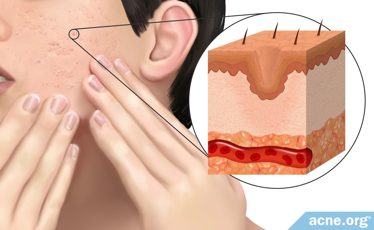 what-causes-a-pimple-to-scar-acne