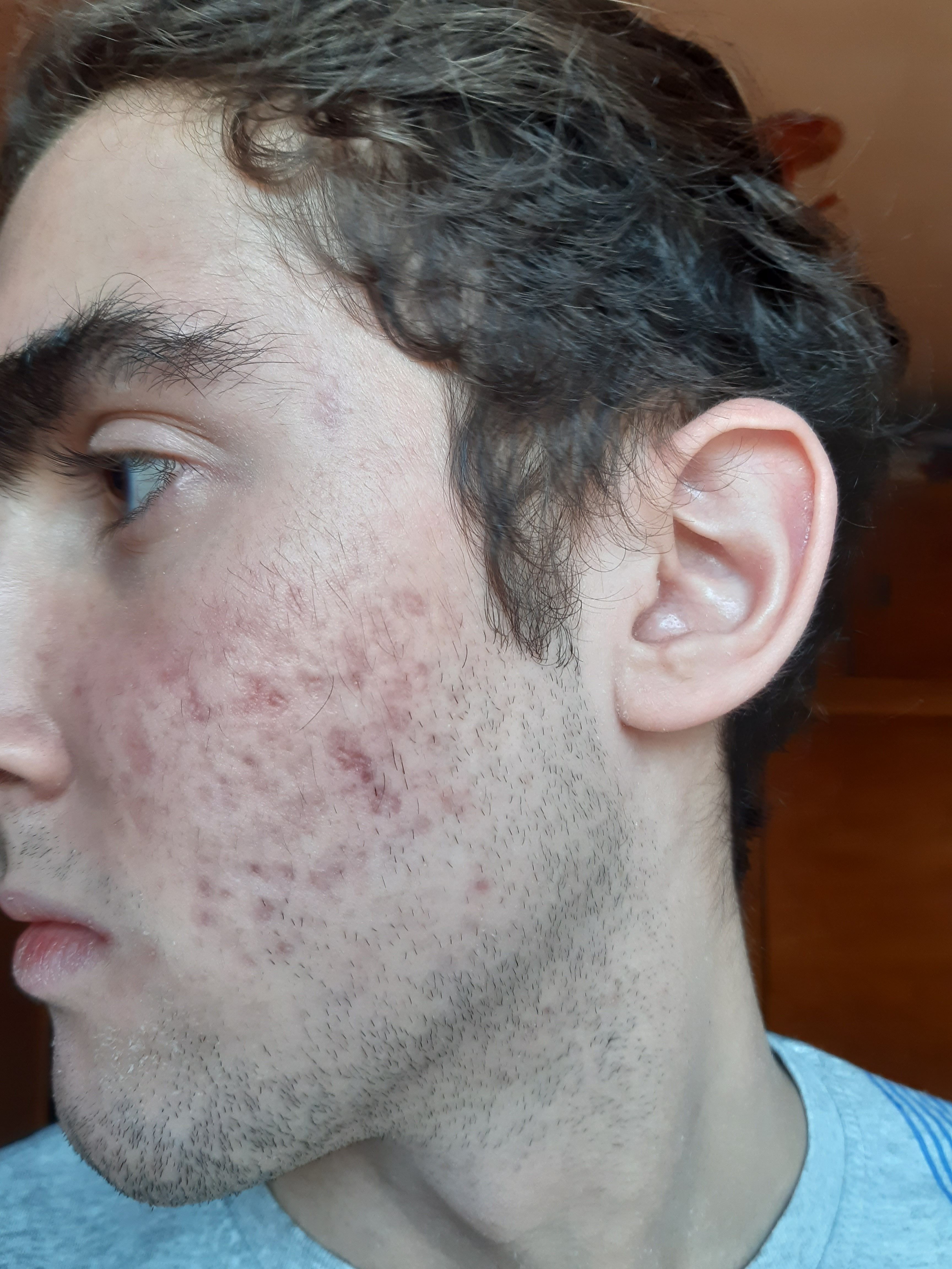 Moderate to severe acne scars Scar treatments Forum