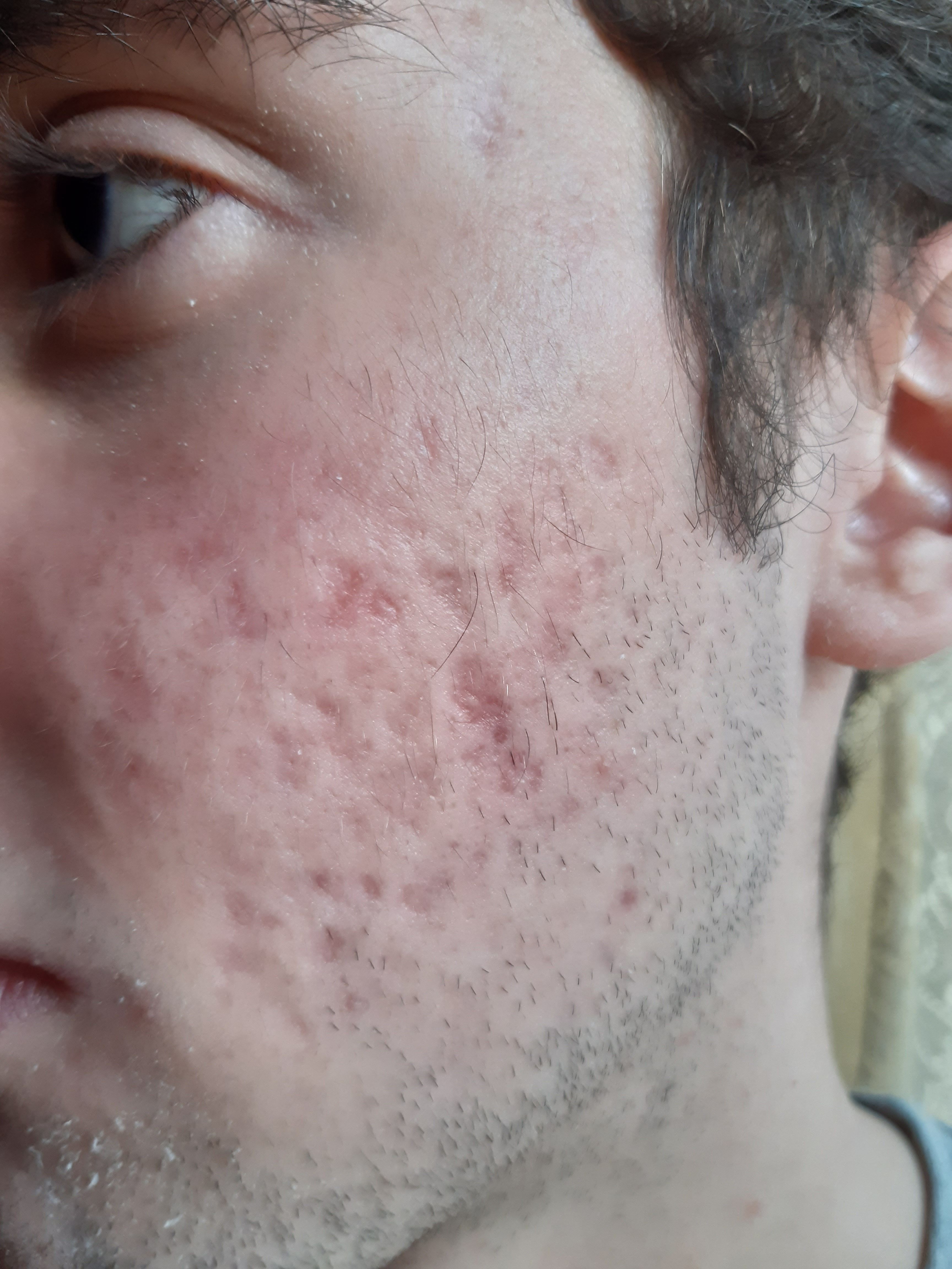 Moderate To Severe Acne Scars Scar Treatments Acne Org Forum