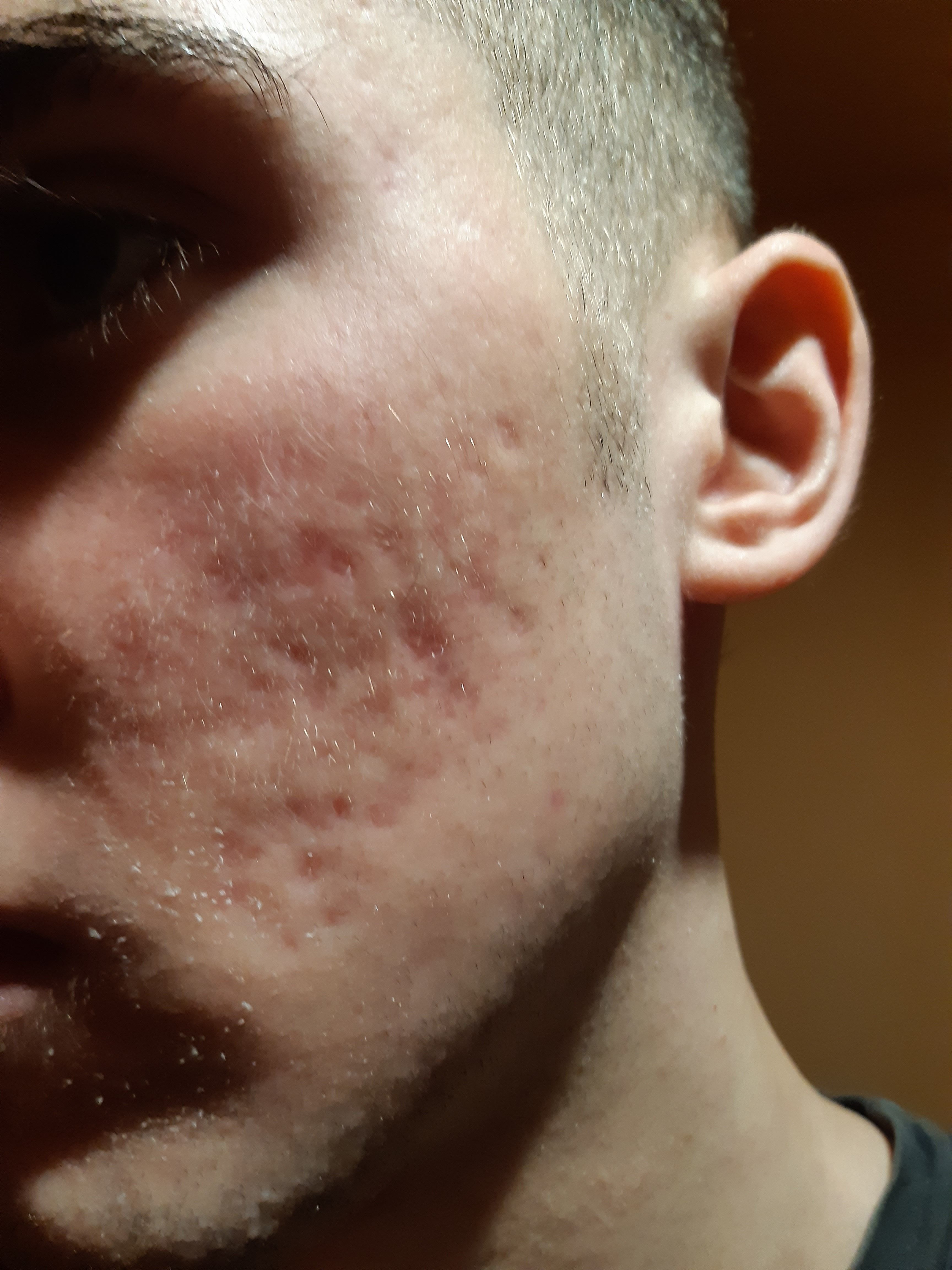 Moderate To Severe Acne Scars Scar Treatments Forum