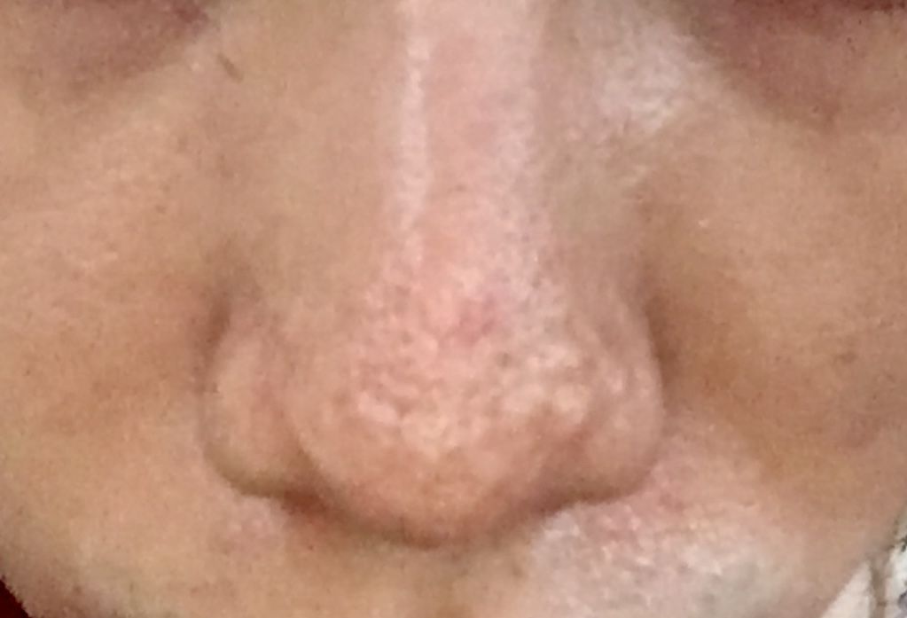 Help Hypertrophic Raised Bumpy Acne Scarring On My Nose Scar Treatments Acne Org Forum