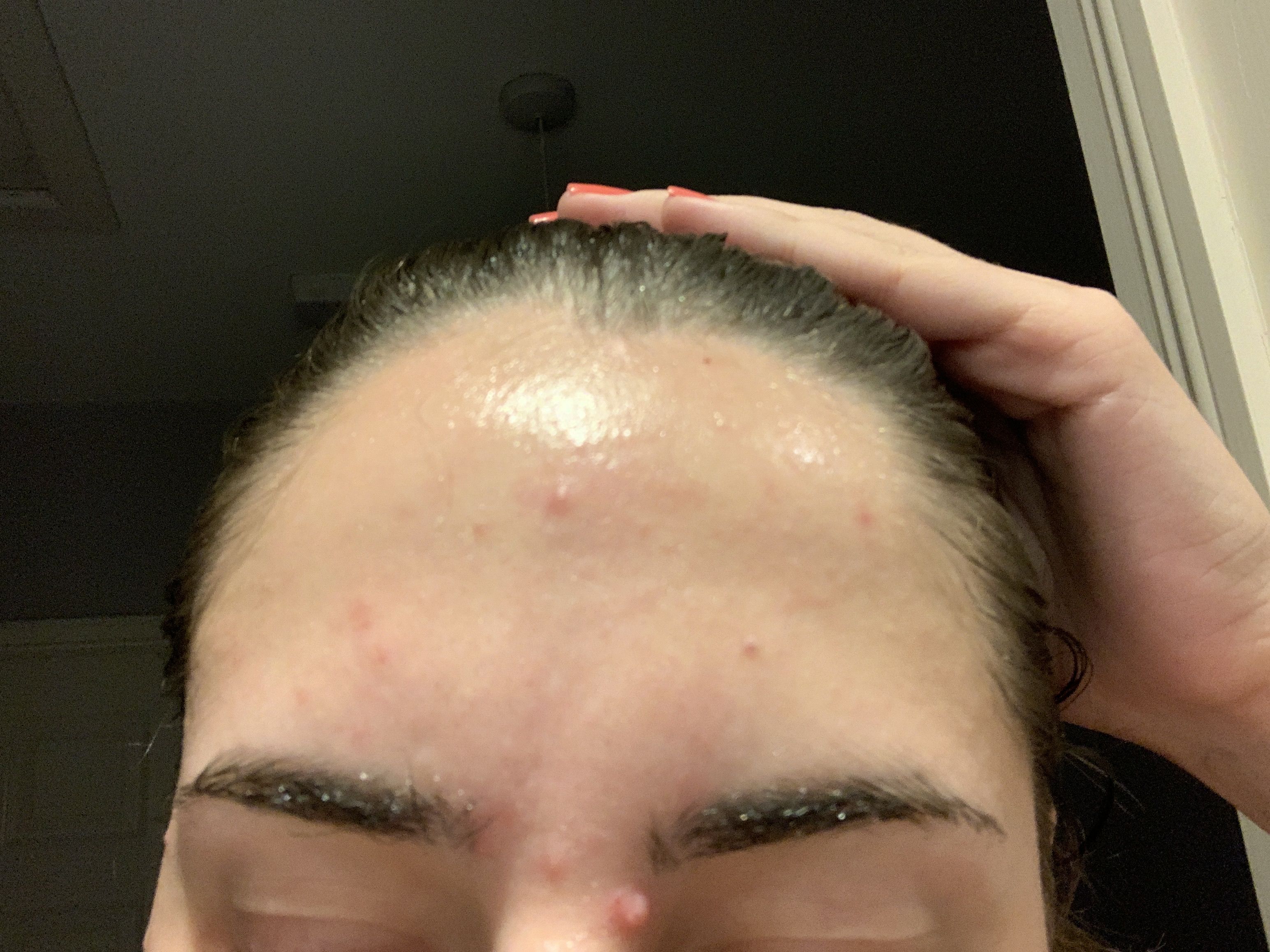 Purging from Mandelic Acid (AHA) General acne discussion