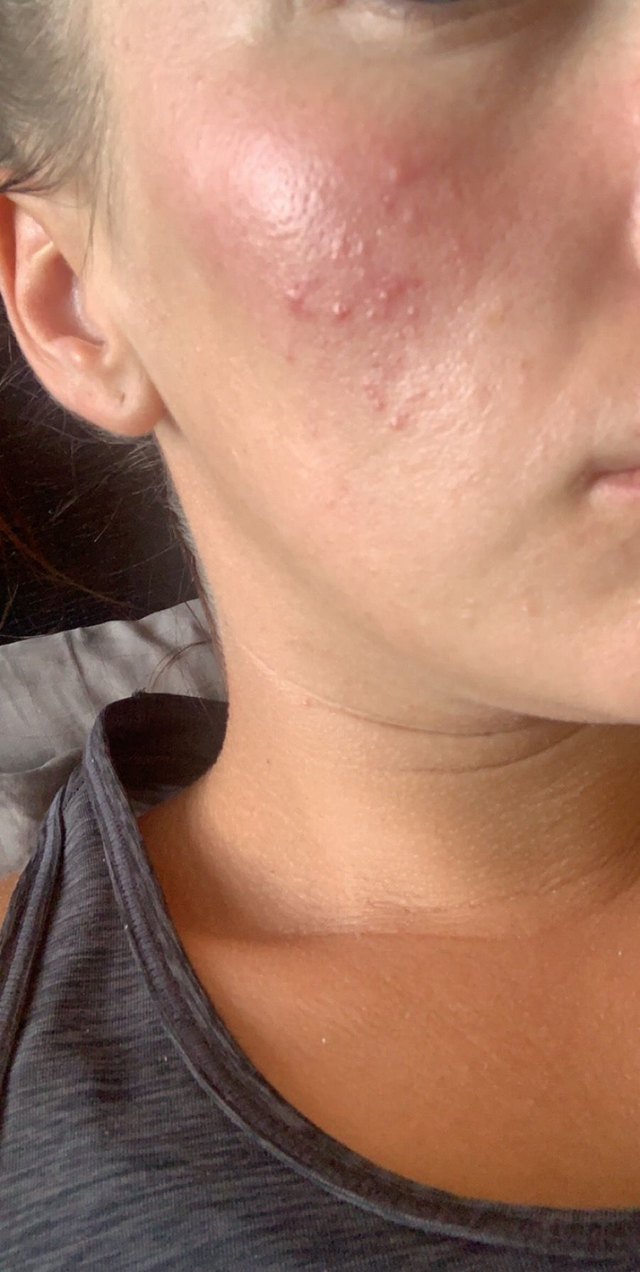 Acne or skin infection? - General acne discussion - Acne.org