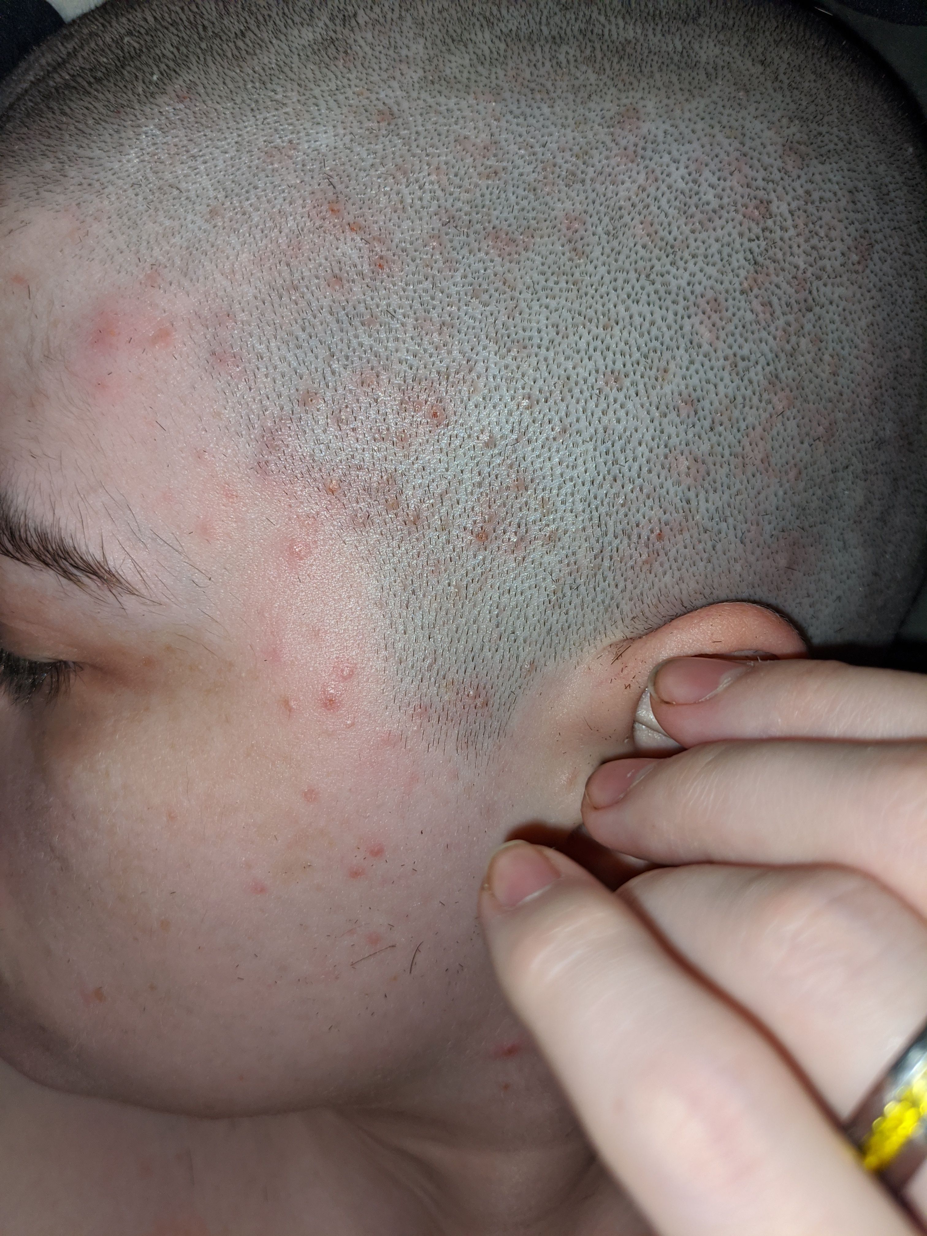 Is It Possible To Have Pimples On Your Head