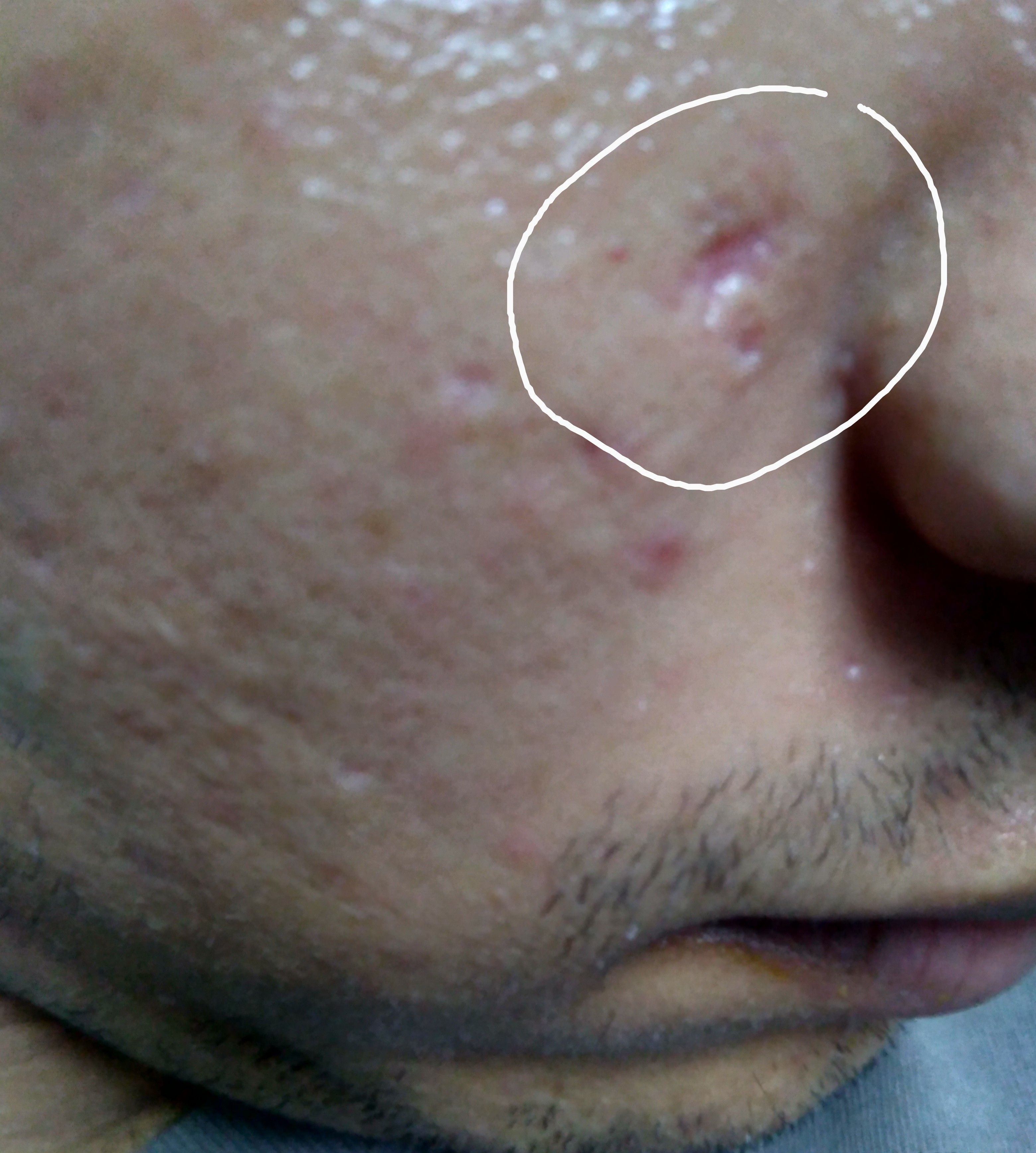 Chicken Pox Scars After Excision What Next Scar Treatments Acne   P 20200604 164219 VHDR On P 1 .bd3f4b5b4d3fece69551221a8462231a 