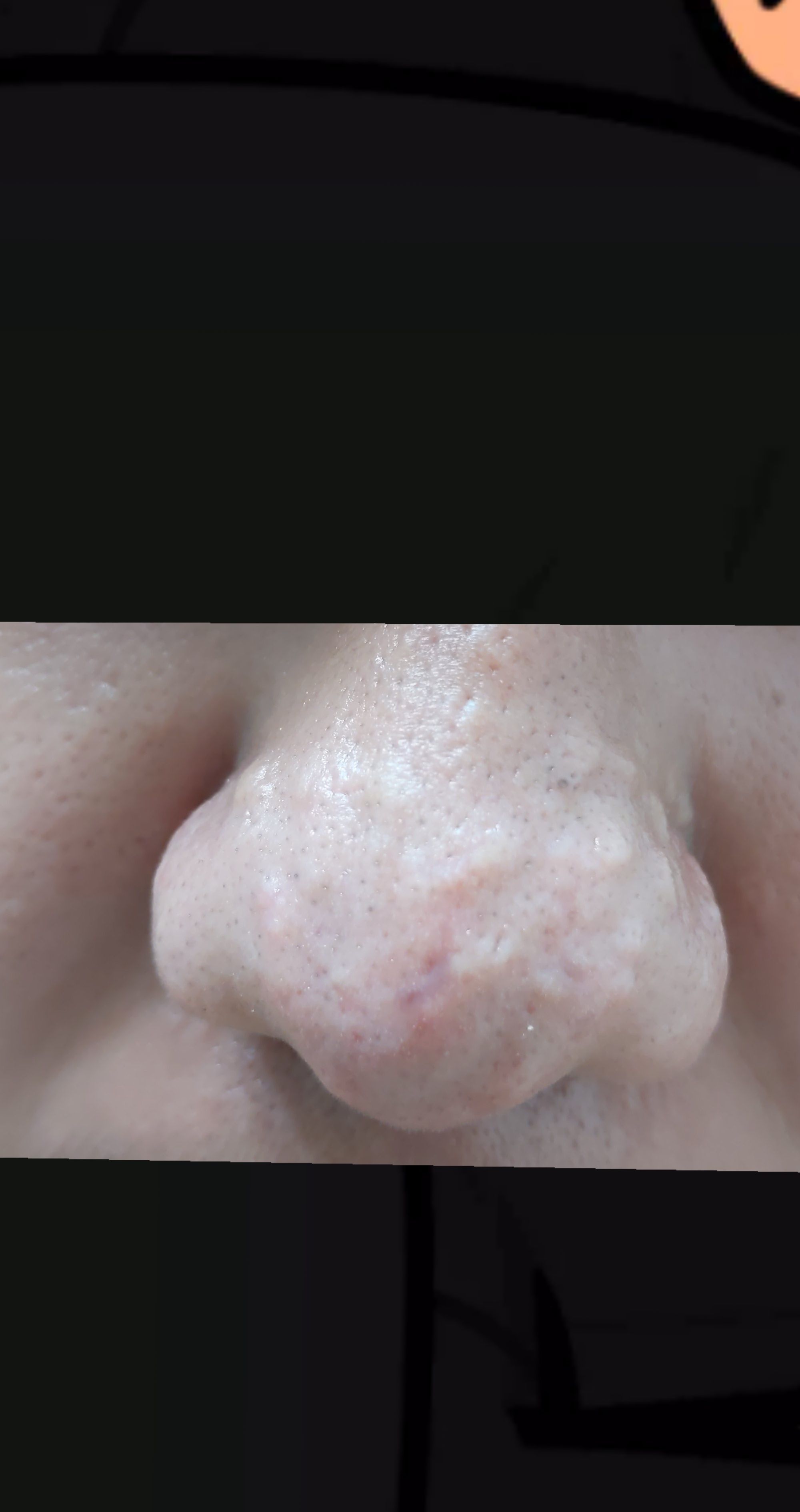 Bumps On Nose Need Help Suggestions Advice Hypertrophic Raised