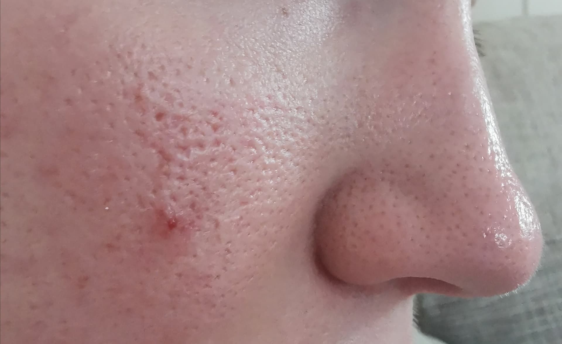 Severely enlarged pores - General acne discussion - Acne.org