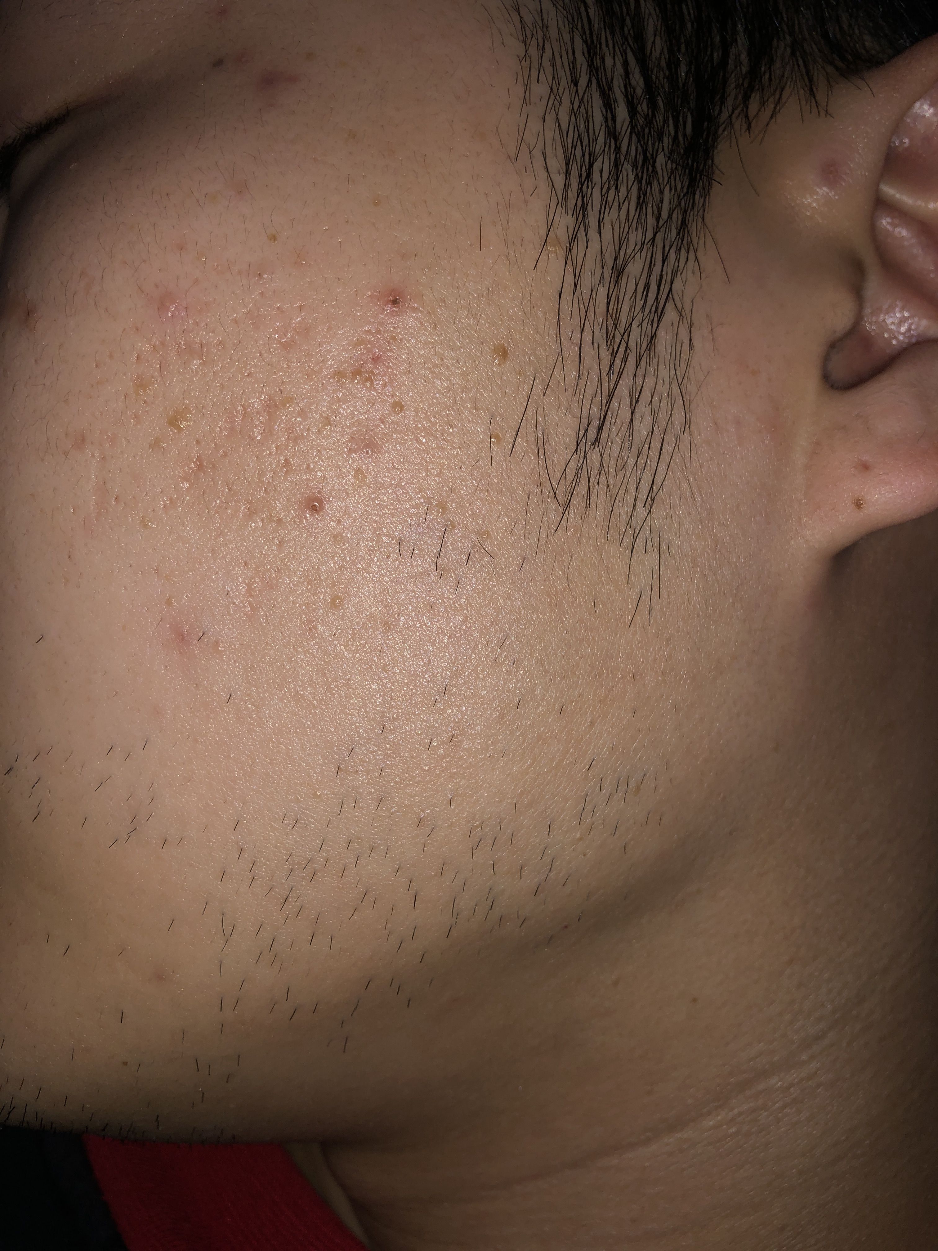 How should I treat my acne scars? - Scar treatments - Acne.org