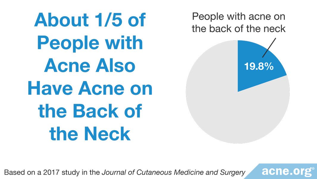 Neck Acne Treatment - Acne.org