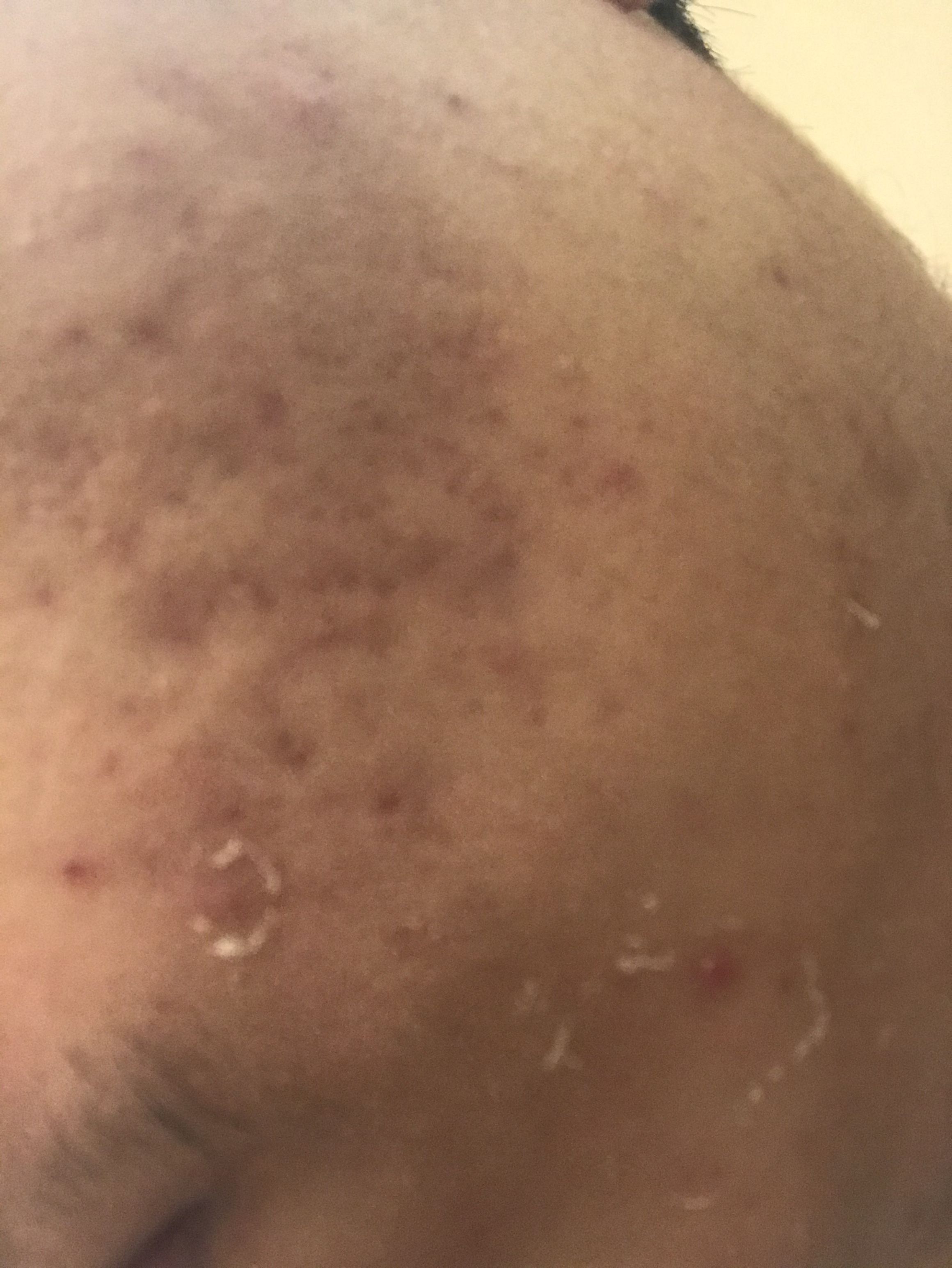 Help needed getting rid of acne/acne scars! - Scar treatments - Acne.org
