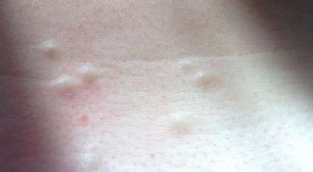 Small lumps under skin on chest What are they? Can you please help