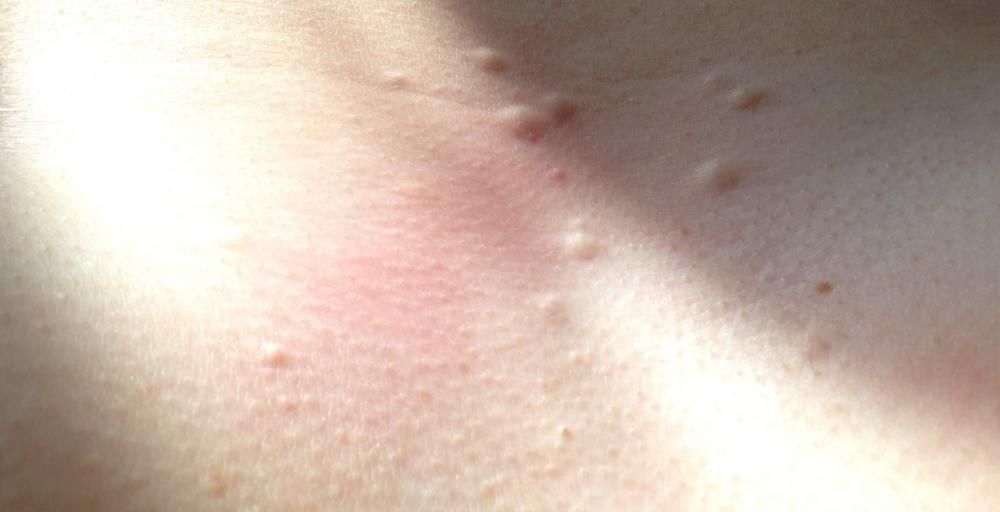 Small Lumps Under Skin On Chest What Are They Can You Please Help Back Body Neck Acne