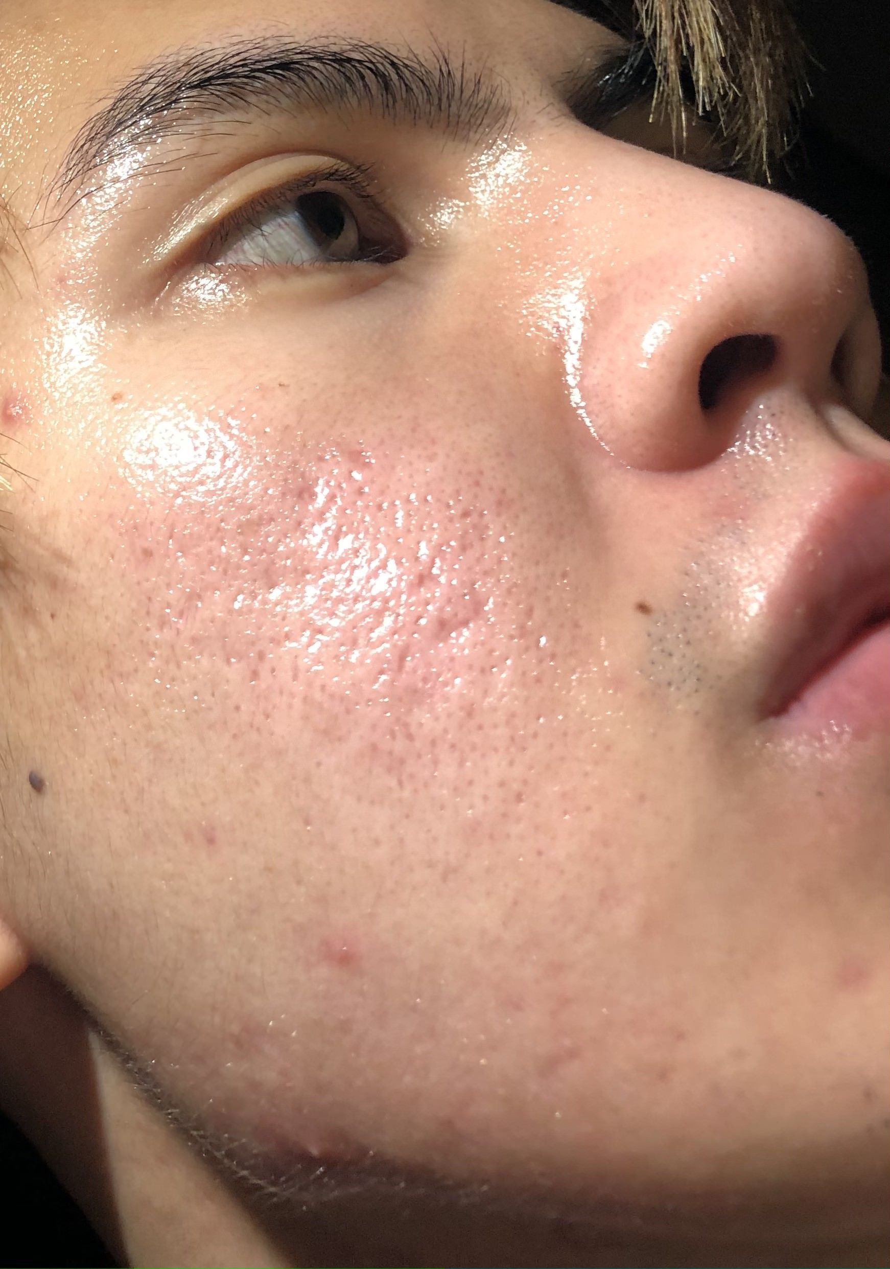 25 years old asian male with acne scars need some treatment advices