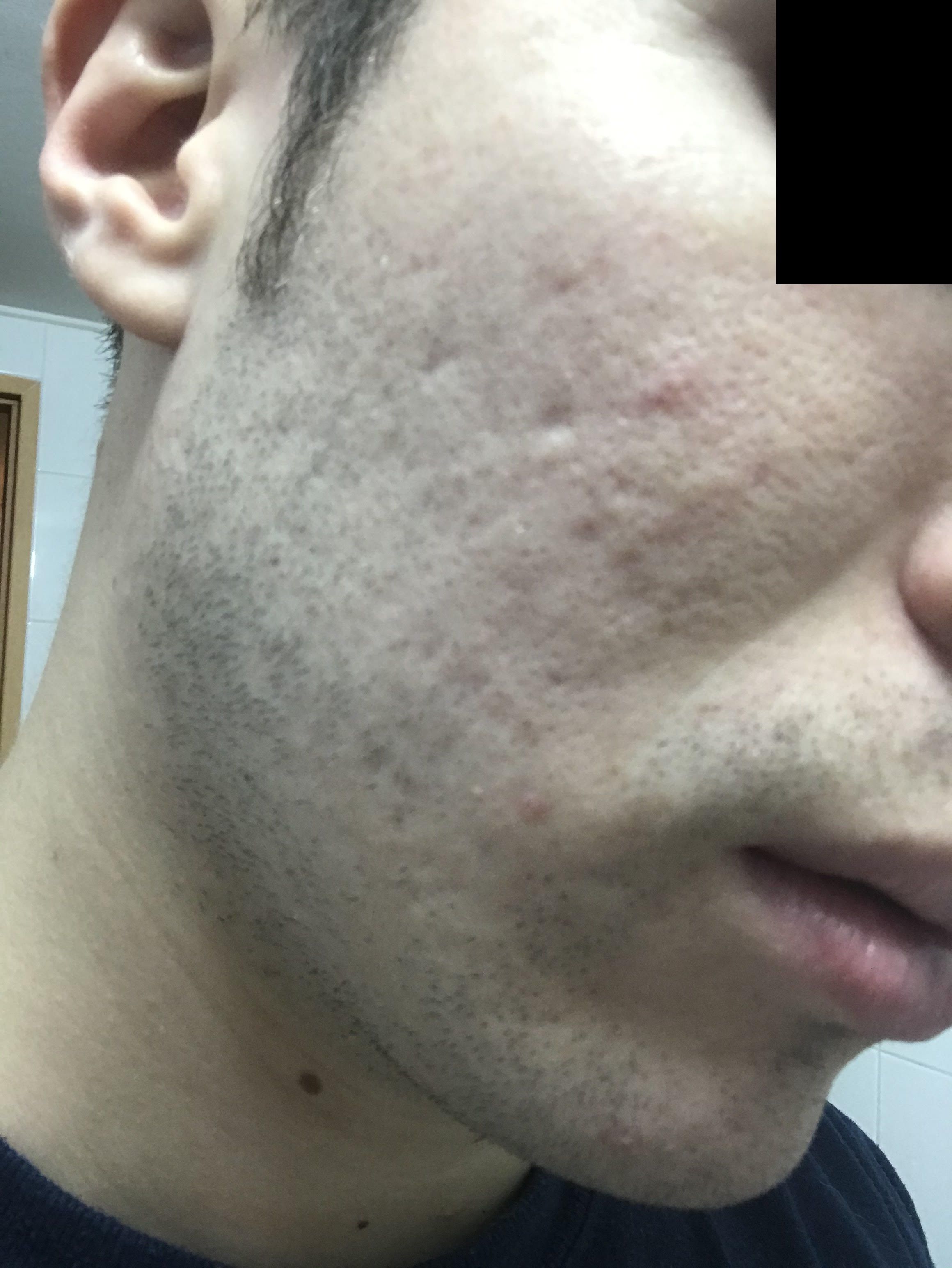 Best Acne Scar Treatment In Korea Scar Treatments Acne Forum