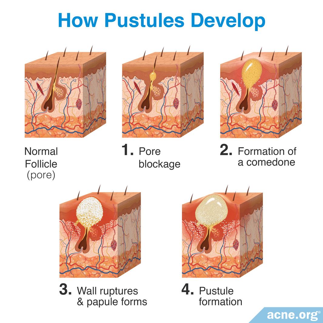 What Is An Acne Pustule Acne