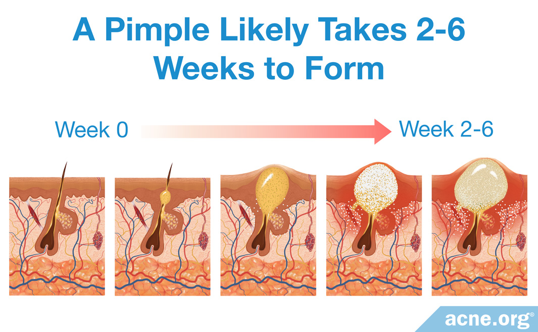 how-long-does-it-take-for-a-pimple-to-form-acne