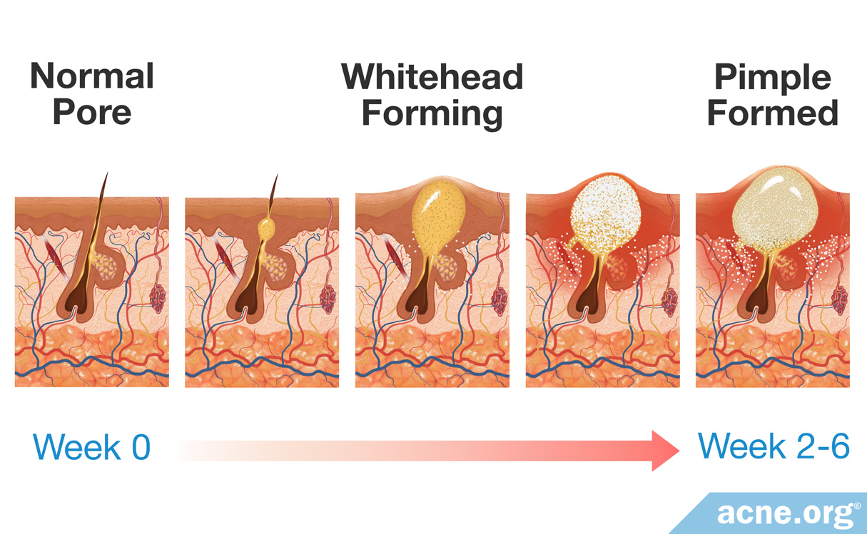 how-long-does-it-take-for-a-pimple-to-form-acne