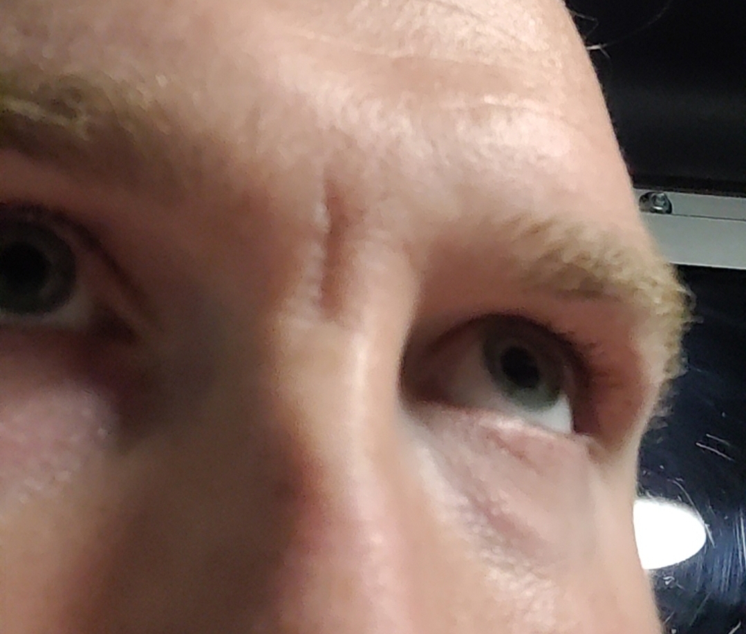 One big scar between eyebrows - Scar treatments - Acne.org