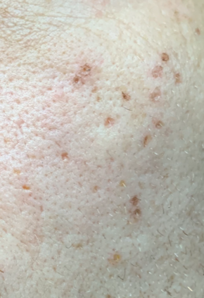 Acne Scarring | Treating ice picks with TCA Cross (images included ...