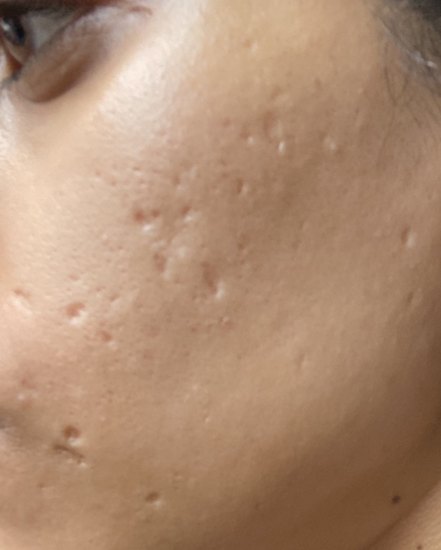 Atrophic Scars Caused By Chicken Pox Other Acne Treatments Acne Org   D7B3695C 9FE5 4EBB 9524 A43ADC2F8269 .ecb80fb38a7c55ed127baec5d685404d 