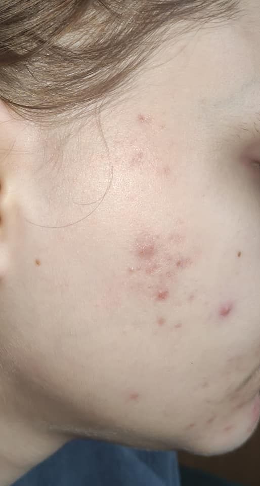 What could be the cause of this acne?