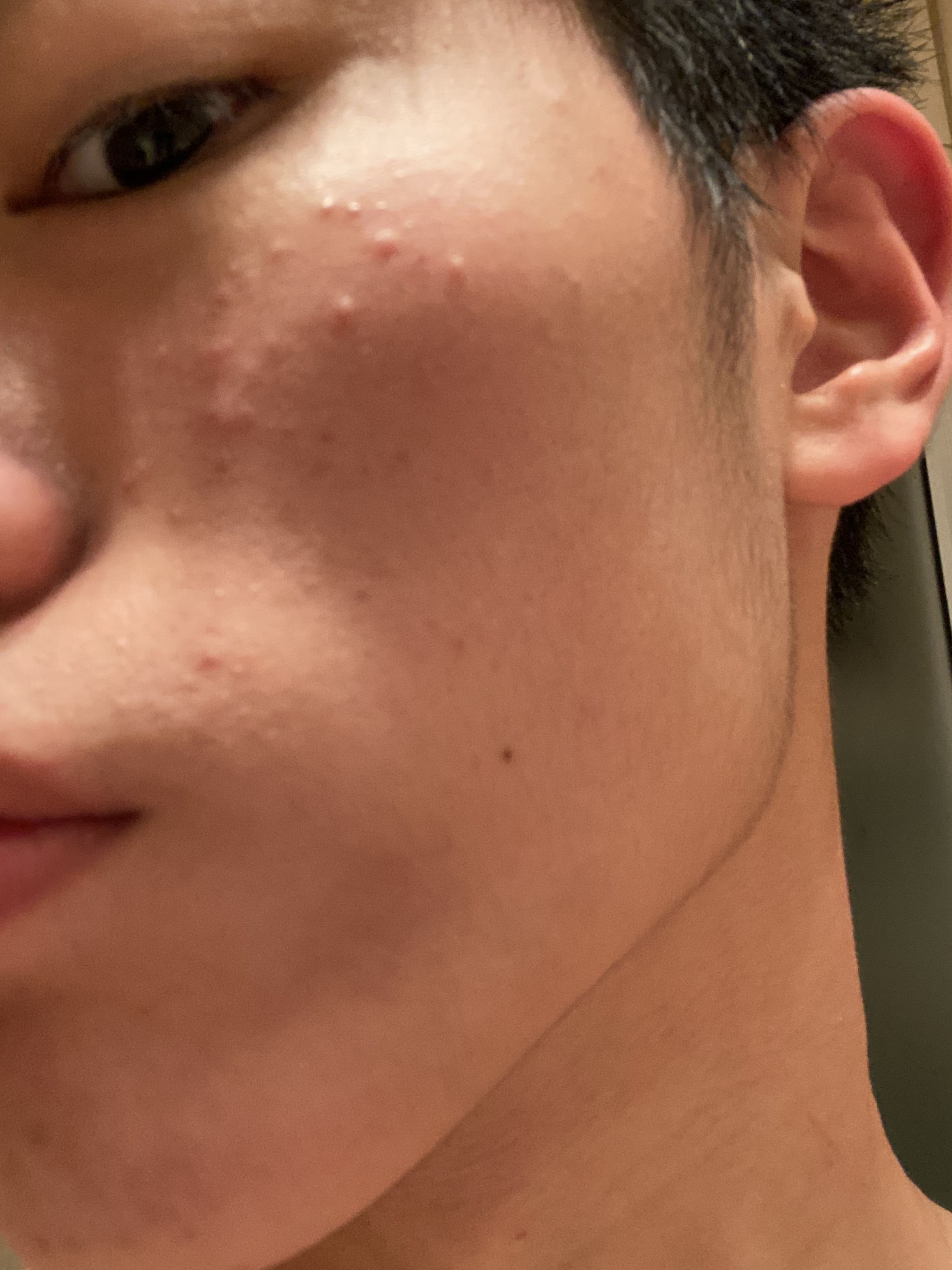 Mild Acne Please Help - General acne discussion - Acne.org