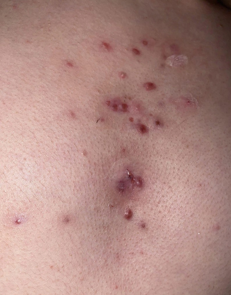 Acne in between breast – Back/Body/Neck acne –  Forum