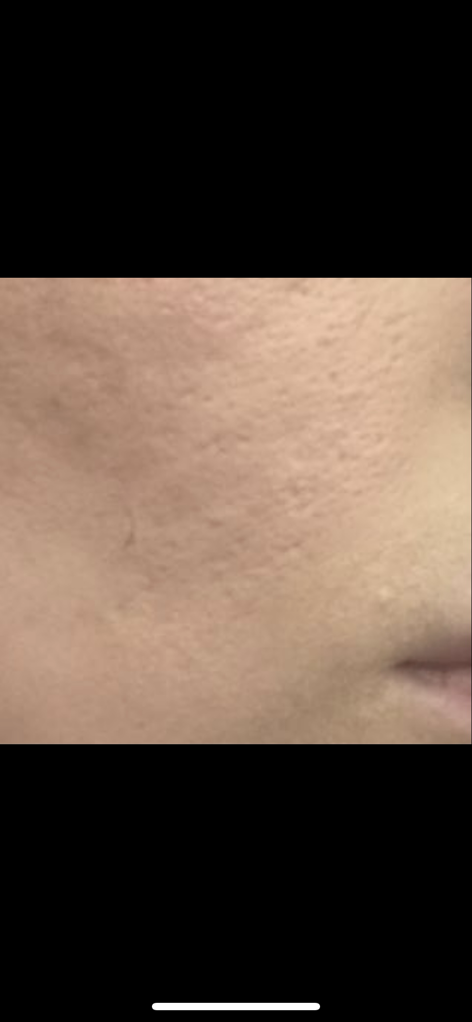 Punch excision left really bad scar… Scar treatments